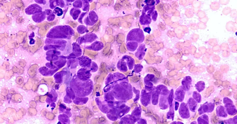 Breast cancer analysis