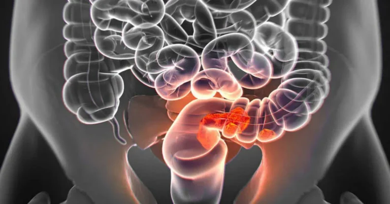 Colon cancer