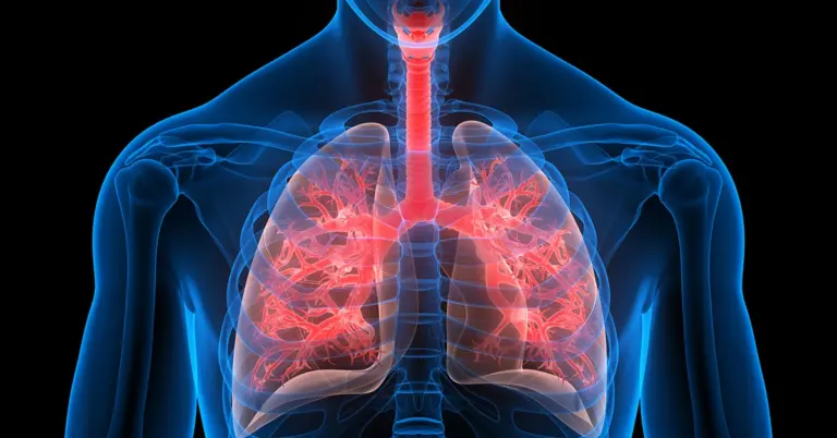 Lung cancer