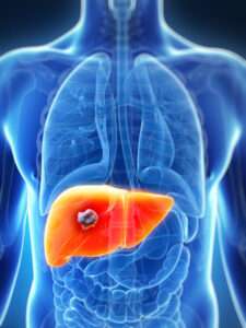 Liver metastasis