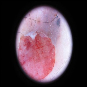 Dermoscopic image ISIC_0000004 (malignant label, testing subset)