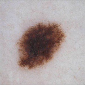 Dermoscopic image ISIC_0000028 (benign label, testing subset)