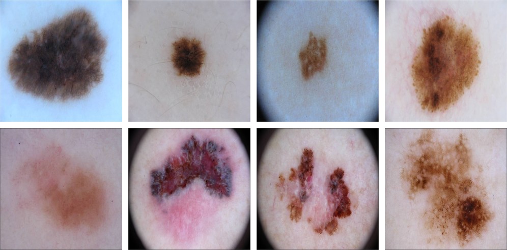 Eight dermoscopic training images: four benign lesions in the top row and four melanomas in the bottom row